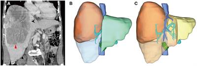 Case Report: Massive Hepatocellular Carcinoma Complete Surgical Resection After Portal Vein Embolization and Multimodality Therapy